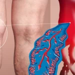 Waspada Varises Sejak Dini, Gangguan Pembuluh Darah Vena