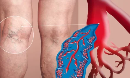 Waspada Varises Sejak Dini, Gangguan Pembuluh Darah Vena