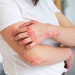 Alergi Makanan Bisa Sembuh, Ini Dia Beberapa Gejalanya!